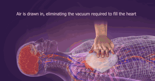 【科普篇】心肺复苏CPR 心肺脑肺复苏_媚心媚肺明月珰微盘_心肺复苏