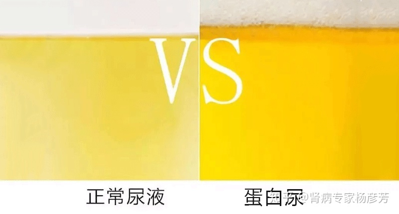 膀胱冲洗怎么记尿量 尿量少尿无力是什么原因_尿量少尿频是什么原因_尿量