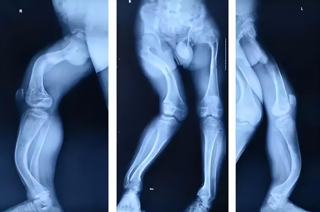 补钙吃钙片真的有用吗_含钙高的食物_吃钙补钙是最大骗局